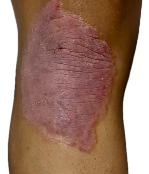 Psoriasis